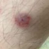 男性二期梅毒的症状