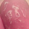 汗疱疹和手癣的症状区别有什么
