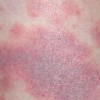 皮炎病因需加以足够注重 怎样预防患皮炎