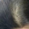 治疗脱发斑秃的三步疗法