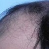 脂溢性脱发怎样预防