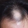 脂溢性脱发如何治