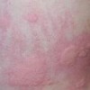 患有丘疹性荨麻疹的症状有哪些