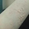 荨麻疹你不晓得的危害