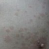 花斑癣的发生应如何治疗