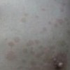 花斑癣的治疗措施是啥