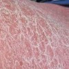 慢性牛皮癣的症状
