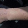 慢性关节型牛皮癣发病的病因有什么