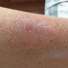 牛皮癣病因有以下几种