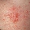 皮肤异痒有什么预防措施