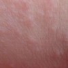 皮肤异痒症的病因有什么
