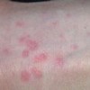 丘疹性荨麻疹的常见预防措施