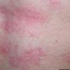 丘疹性荨麻疹详细得症状