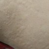 人工荨麻疹你明了吗