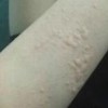什么叫脱敏治疗