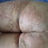 小儿鱼鳞病表现有啥
