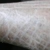 板层状鱼鳞病是啥样的呢