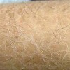 表皮松解性角化过度鱼鳞病的临床体现有些啥