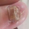 灰指甲的发病病因有什么