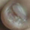 导致灰指甲的4大常见病因