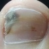 常常看见的先天性灰指甲症状