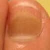 灰指甲的导致条件有哪些