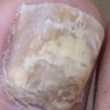 灰指甲的病因都包含什么呢
