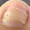 灰指甲的初期有哪些体现