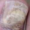 灰指甲初期病情的辨别措施