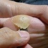 怎样区分鸡眼和跖疣