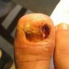 甲沟炎患者平时请求留心哪些