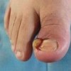 甲沟炎患者不能吃什么