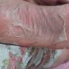 脚气的简单医治的方法