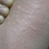皮肤所以过敏的病因有什么