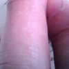 皮肤过敏源的四大分类