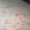 皮肤过敏有一些什么类型