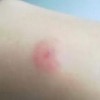 长疥疮怎么办