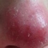 酒糟鼻的发生特点引荐