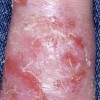 常见湿疹的有什么原因呢