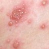 常常看见的几种诱发湿疹的原因