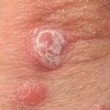 沧州过敏性湿疹有哪些常常看见的症状表现