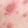 典型湿疹的症状有哪些呢