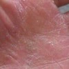 手癣足癣手足癣癣是最常见的皮肤疾病青岛百姓皮肤病医院