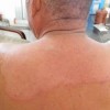 体癣该小心些什么呢
