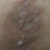 体股癣的体现体现是啥