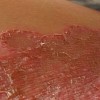 体癣的症状及治疗