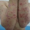 体股癣的症状特点是啥