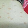 玫瑰糠疹的多发期我们该怎样做