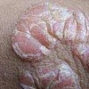 银屑病疾病如何医治作用好