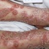 顽固性牛皮癣的临床症状